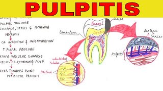 Pulpitis  Pathophysiology Causes amp Types [upl. by Eiltan]