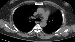 Cross sectional and imaging anatomy of the thorax [upl. by Anidnamra211]