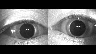 Verticalrotatory geotropic nystagmus in right pBPPV Canalolithiasis [upl. by Almap702]