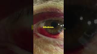 Understanding Trachoma Causes Symptoms 2024 10 22 [upl. by Yran70]