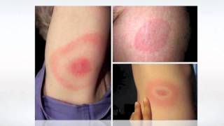 Lyme Disease Pictures  wikiSymptoms [upl. by Nunnery]