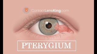 Pterygium Eye Surfers Eye Treatment Causes and Symptoms [upl. by Aretak]