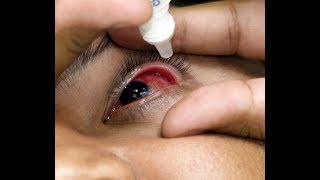 ¿Qué es la Conjuntivitis Cuáles son sus síntomas y cómo prevenirlo [upl. by Suired72]