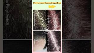 Best Pharmacy Shampoo for Dandruff free Hairspharmacy haircare dandruff ytshorts shorts [upl. by Ettezoj]