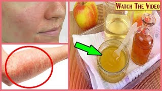 How To Cure Eczema With Apple Cider Vinegar [upl. by Attenweiler69]