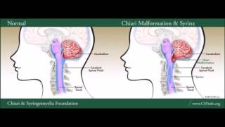 Chiari Malformation amp Syringomyelia [upl. by Urina775]