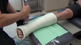 Removing and Bivalving a Cast [upl. by Dix]