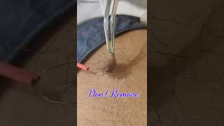 Dont Remove Skin Tag In Your Body zackdfilms [upl. by Akyeluz]