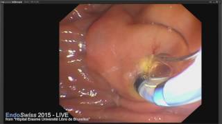 EndoSwiss 2015 LIVE case ERCP wih biliary sphincterotomy and stenting for palliative purpose [upl. by Asilegna892]