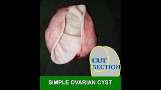 SIMPLE OVARIAN CYST [upl. by Aydin550]