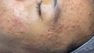 ACNE TREATMENT VU QUYNH MI Acne On Teens Nose 2024 [upl. by Yeleek]