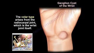 Ganglion Cyst Wrist  Everything You Need To Know  Dr Nabil Ebraheim [upl. by Goode]