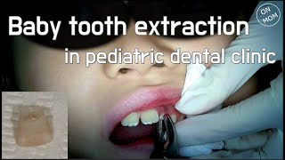 Baby tooth extraction in pediatric dental clinic [upl. by Eillime365]