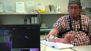 BrainComputer interface used for rehabilitation after a stroke [upl. by Kara-Lynn]