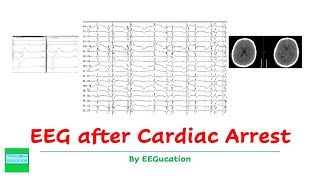 EEG After Anoxic Brain Injury [upl. by Emery23]