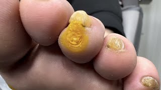 Removal of Multiple Warts and Calluses [upl. by Gonroff725]