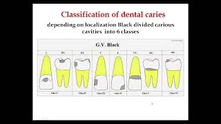 Classification of dental caries  classes of caries [upl. by Irah]