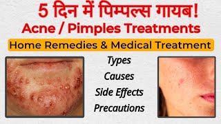 Pimples Removal  Acne Treatment at home  Pimples Removal on face at home  How to Treat Acne [upl. by Leoine35]