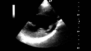 A video ultrasound scan of the heart beating [upl. by Rutherford]