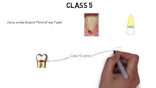 GVBlacks classification of dental caries quick and complete revision [upl. by Westbrooke]