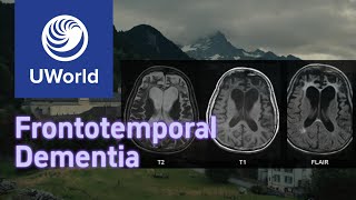 Frontotemporal Dementia vs Alzheimer Disease with Histology  UWorld USMLE MBBS [upl. by Elocan]