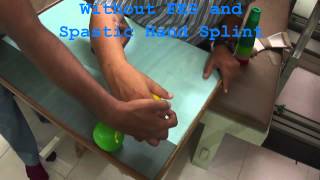 SHS Spastic Hand Splint for spastic hemiplegic hand at Hope Neuro care hospital Ahmedabad [upl. by Cynthy624]