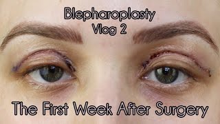 My Eyelid Surgery 1st Weeks of Recovery  Cosmetic Blepharoplasty Diary Part 2 [upl. by Kline]