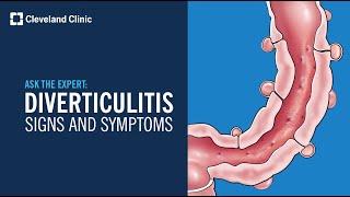 Warning Signs of Diverticulitis  Ask Cleveland Clinics Expert [upl. by Enael285]