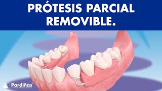 Prótesis parcial removible  ¿Cómo funcionan © [upl. by Yila]