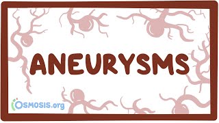 Aneurysms  causes symptoms diagnosis treatment pathology [upl. by Akiam485]