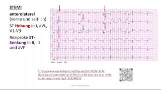 Herz 11 EKG 4  STEMI Perikarditis Extrasystole Kammerflimmern [upl. by At]