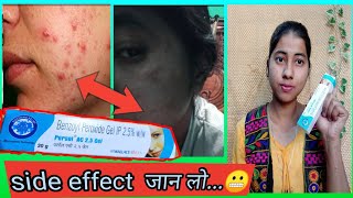 Benzoyl Peroxide Gel 25 Review In Hindi  Uses And Side Effect  miss glossy girl [upl. by Selmner]