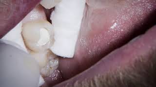 Biodentine  occlusal cavity replacement [upl. by Habeh]