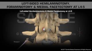 Leftsided Hemilaminotomy Foraminotomy amp Medial Facetectomy at L45 [upl. by Rehpinnej694]