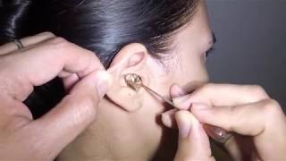 Womans Earwax Finally Removed after 25 Years [upl. by Fanestil]