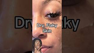 Dry Flaky Skin 👩🏾✨💜💫 [upl. by Nue]