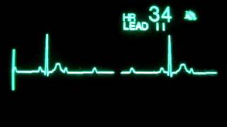 2nd Degree Atrioventricular Block Type II with 31 Block [upl. by Neirol]