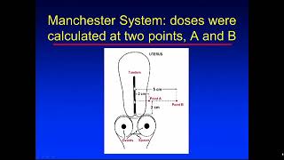 Brachytherapy 2 [upl. by Staley]