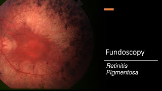 Retinitis Pigmentosa Fundoscopy [upl. by Islehc]