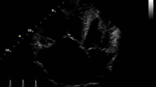 ACUTE PULMONARY HEART DISEASE  THROMBUS PULMONARY ARTERY [upl. by Kesley]