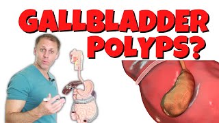 Why Do I Have Gallbladder Polyps [upl. by Haimerej]