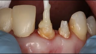 Dental Core Build Up and Post Cementation  Dental Online Training [upl. by Niwhsa]