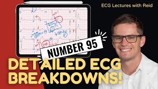 EKG Test Yourself  ECG Case Study 95 [upl. by Asihtal]