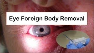 Eye Foreign Body Removal [upl. by Dajma770]