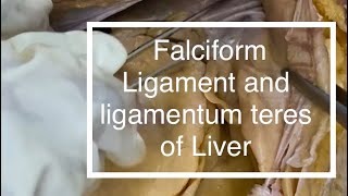 Peritoneum Falciform ligament Ligamentum teres of Liver [upl. by Dieter]