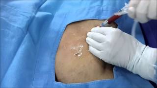 Ultrasound Guided Axillary vein Catheterization [upl. by Clyve454]