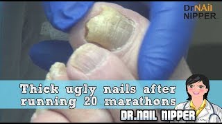 Runners Toenails can be Tough Thick Ugly Nails After Running 20 Marathons  Dr Nail Nipper [upl. by Nataniel982]