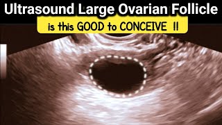 what is Large Ovarian Follicle  is it GOOD to CONCEIVE  TVS Ultrasound [upl. by Alguire463]