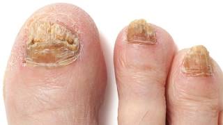 Soaking Feet in Apple Cider Vinegar For Toenail Fungus Does It Work [upl. by Acalia]