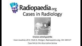 Erosive antral gastritis Radiopaediaorg Cases in Radiology [upl. by Johnstone]